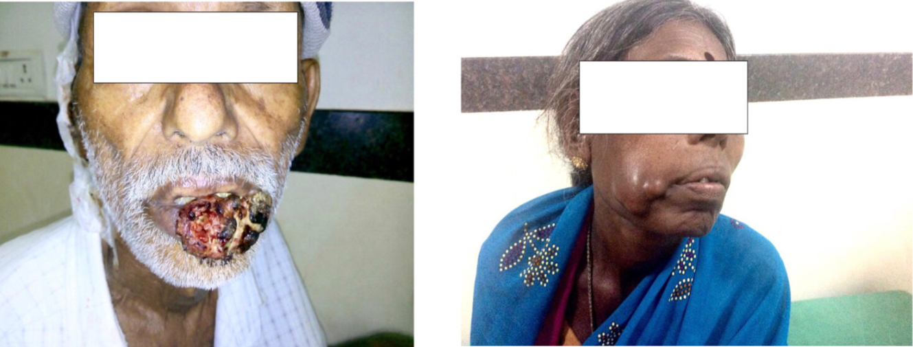 Gross photograph of Squamous cell carcinoma of Lip, B: Gross photograph of Squamous cell carcinoma of Right Cheek