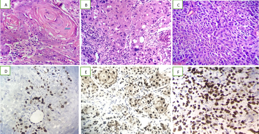 Microphotograph showing keratin pearls in well differentiated squamous cell carcinoma [H&E 10x10]; B: Microphotograph showing moderately differentiated squamous cell carcinoma (H&E-10x40); C: Microphotograph showing poorly differentiated squamous cell carcinoma (H&E-10x40); D: Microphotograph showing nuclear immuno-expression of Cyclin D1 in well differentiated squamous cell carcinoma (score-<10%) (IHC, 10x40); E: Microphotograph showing nuclear immuno-expression of Cyclin D1 in moderately differentiated squamous cell carcinoma (score 45%) (IHC, 10x40); F: Microphotograph showing nuclear immuno-expression of Cyclin D1 in poorly differentiated squamous cell carcinoma (score-85%)(IHC,10x40)