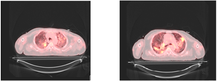 A repeated PET CT showed no radiological improvement and uptake noted in the left upper lobe. Liposomal Amphotericin B dose increased to 10 mg/kg/day as the patient is not improving.