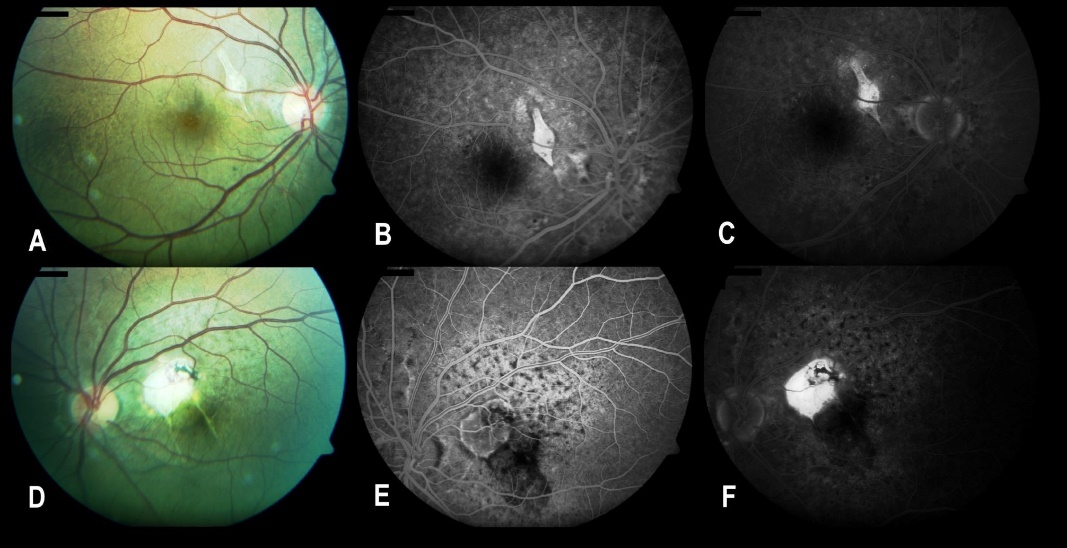 After injections of bevacizumab there is no leakage from the CNVM in the right eye (B and C). In the left eye small leakage is seen from the CNVM in the left eye (E and F). The mottled hyperfluorescence is better seen in early phase angiogram