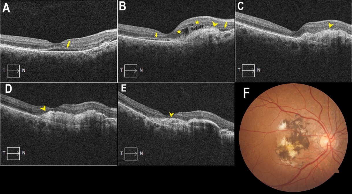 A) OCT image of the macula in the right eye at first visit. Subretinal fluid is observed (arrow). B) At 20 months of follow-up, the patient received a total of 7 injections. The lesion demonstrates fibrous scar (arrow head), intraretinal cysts over the fibrous scar (asterisks), subretinal fluid (arrows). C) At 28 months of follow-up after receiving another 2 injections, arrowhead indicates fibrous scar with no subretinal fluid activity. D) At 4 years of follow-up, after receiving another 11 injections, arrowhead shows fibrous scar extending subfoveally. E) After 7 years of follow-up, the patient received a total of 26 injections, OCT image demonstrates subfoveal fibrous scar. F)  Fundus image of right eye after 7 years. There is a large fibrous scar over macular region. Prominent pigment hypertrophy is seen within the scar