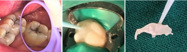 a). Pre-operative picture b). Stamp prepared c). Stamp