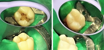 a) Cavity preparation b). Post-operative picture