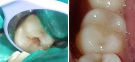 a). Cavity preparation b). Post-operative picture