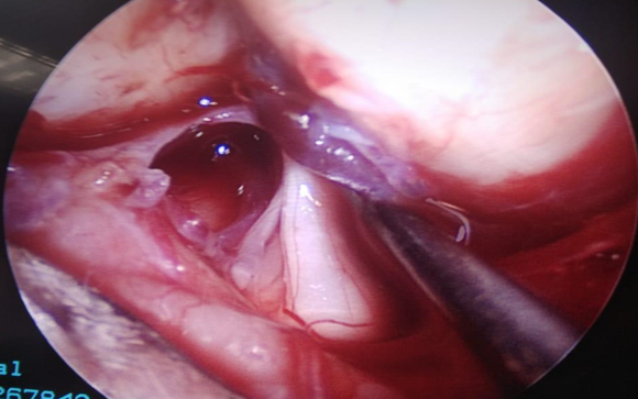 Comprehensive view of the entire Trigeminal nerve