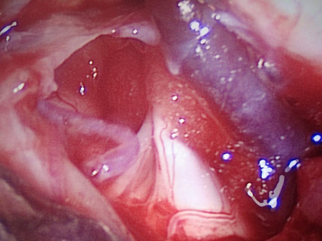 Compressing vessel seen in Endoscopic MVD.