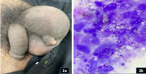 a: Skin swelling in scrotum, b: Cytology smear showing blue amorphous calcific material and anucleated squames (Diff Quik, X100)                      