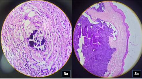 a: Histomorphology showing calcific deposit in centre with gaint cell reaction (H&E, X200); b: Histomorphology showing calcific deposit below stratified squamous lining (H&E, X100)