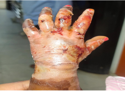 Burn-wound