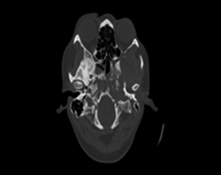 NCCT head showingpermeative osteolytic lesions in basisphenoid including left pterygoid plates also including occipital condyles.