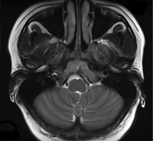MRI brain showin gheterogenous altered signal intensity in basisphenoid, left pterygoid plates with associated soft tissue component.