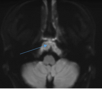 MRI Brain DW Images these lesions showed diffusion restriction
