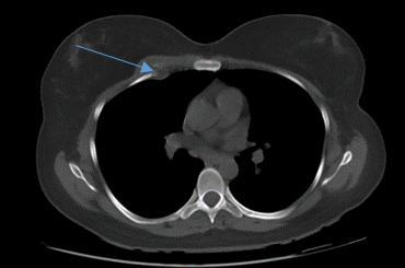 CT chest showsexpansile lytic lesion in anterior 3rd rib