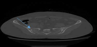 Irregularity was seen along the articular aspects of right sacroiliac joint consistent with Sacroiliitis