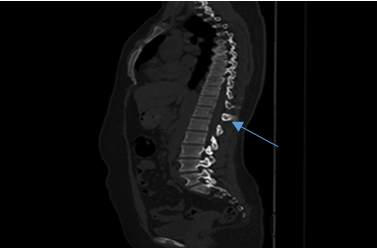 Lytic lesion at D11 Spinous process