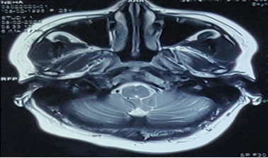 Follow up MRI shows interval reduction in size of lesion, reduction in necrotic component, reduction in marrow edema.