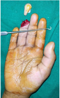 Allen type 4 amputation of the right ring finger Palmar and dorsal view