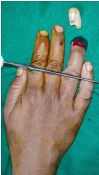 Allen type 4 amputation of the right ring finger Palmar and dorsal view