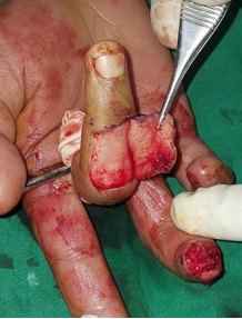 Raising of the flap from the dorsal aspect of the right middle finger