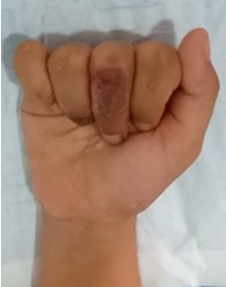 Full flexion of the ring and middle finger