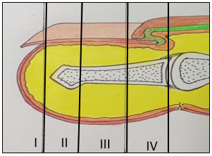 Allen classification of fingertip injuries