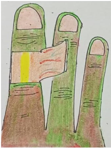 Illustration of cross finger flap raised from dorsum of the finger