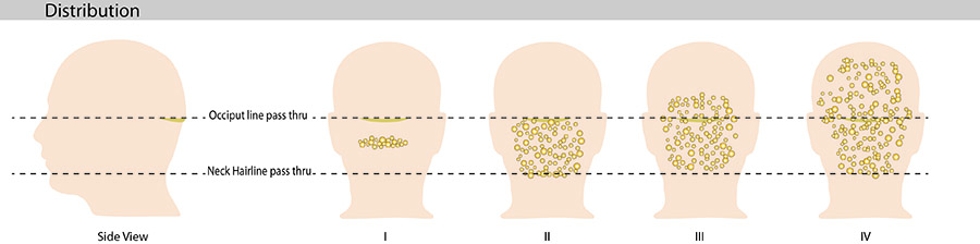 Acne keloidalis nuchae can spread from bumps on the back of the head and neck to bumps across the scalp.