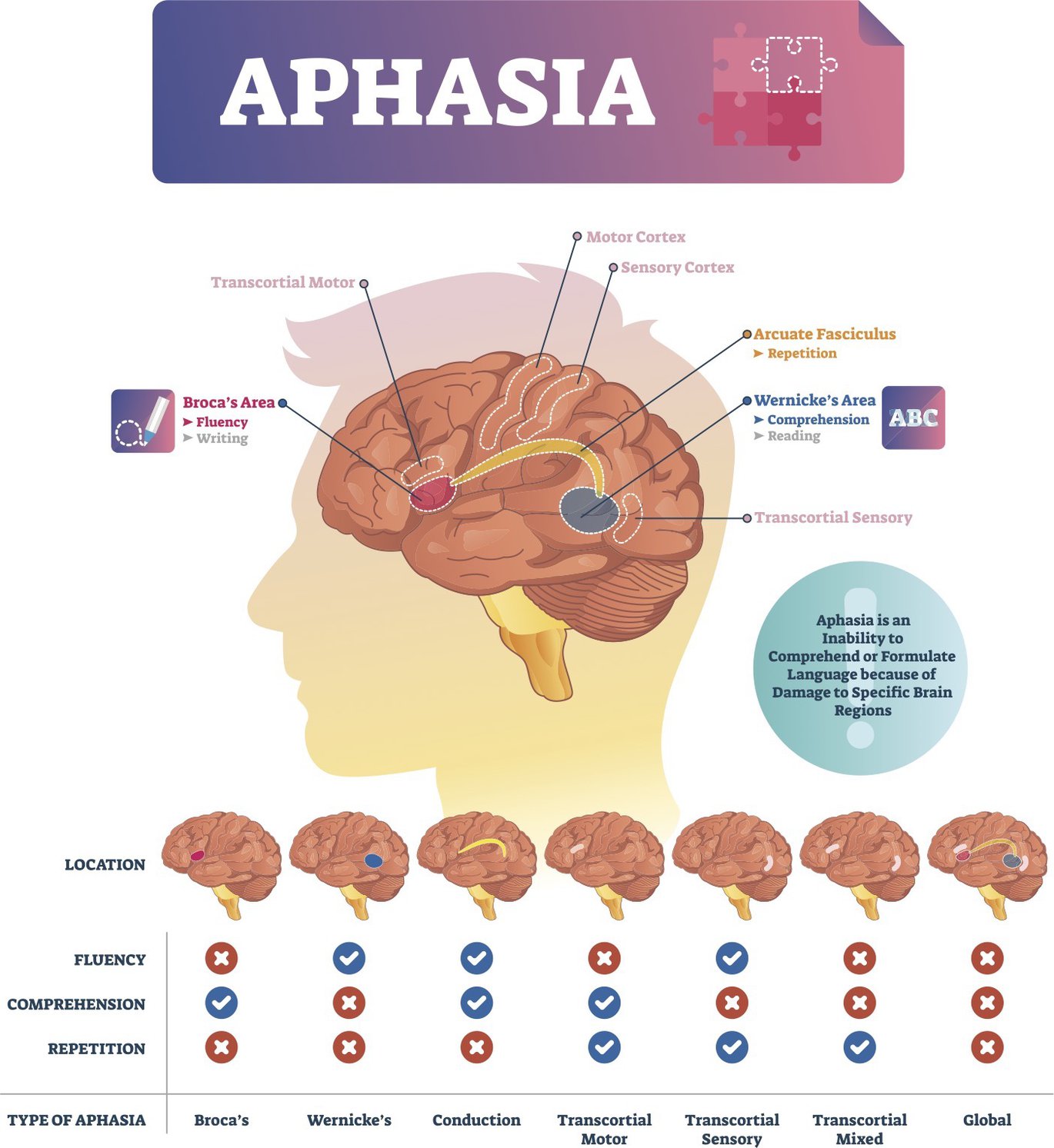 What Is Aphasia And Can Rehab Slow Its Effects UTSW Medblog What is aphasia and can rehab slow its effects utsw medblog