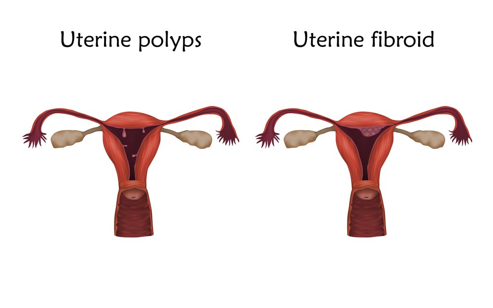 Endometrial Ablation A Popular Solution To Abnormal Bleeding For endometrial-ablation-a-popular-solution-to-abnormal-bleeding-for
