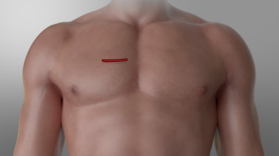 Heart valve surgery without cracking open the chest Heart UT