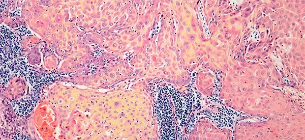Base Of Tongue Cancer Condition Ut Southwestern Medical Center
