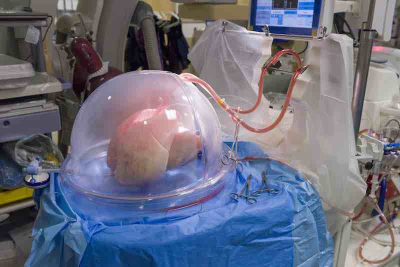 Ex Vivo Lung Perfusion Conditions & Treatments UT Southwestern