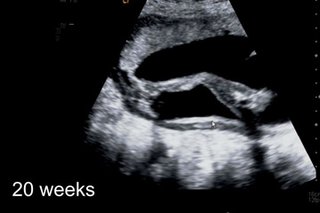 Feeling your baby move during pregnancy | Your Pregnancy Matters | UT ...