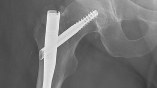 Why hip fractures require immediate treatment