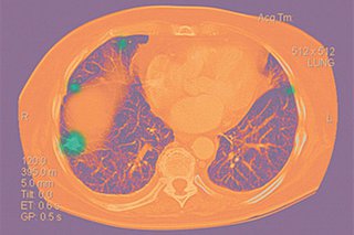 Many Lung Cancers Are Now In Nonsmokers What Experts Want You To Know - 3gvsfsb