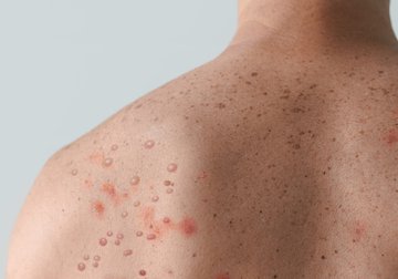 What Texans need to know about mpox | COVID | Prevention | UT