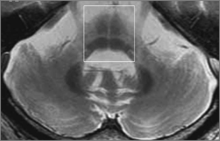 Multiple System Atrophy (MSA) Evaluation | Multiple System Atrophy | UT ...