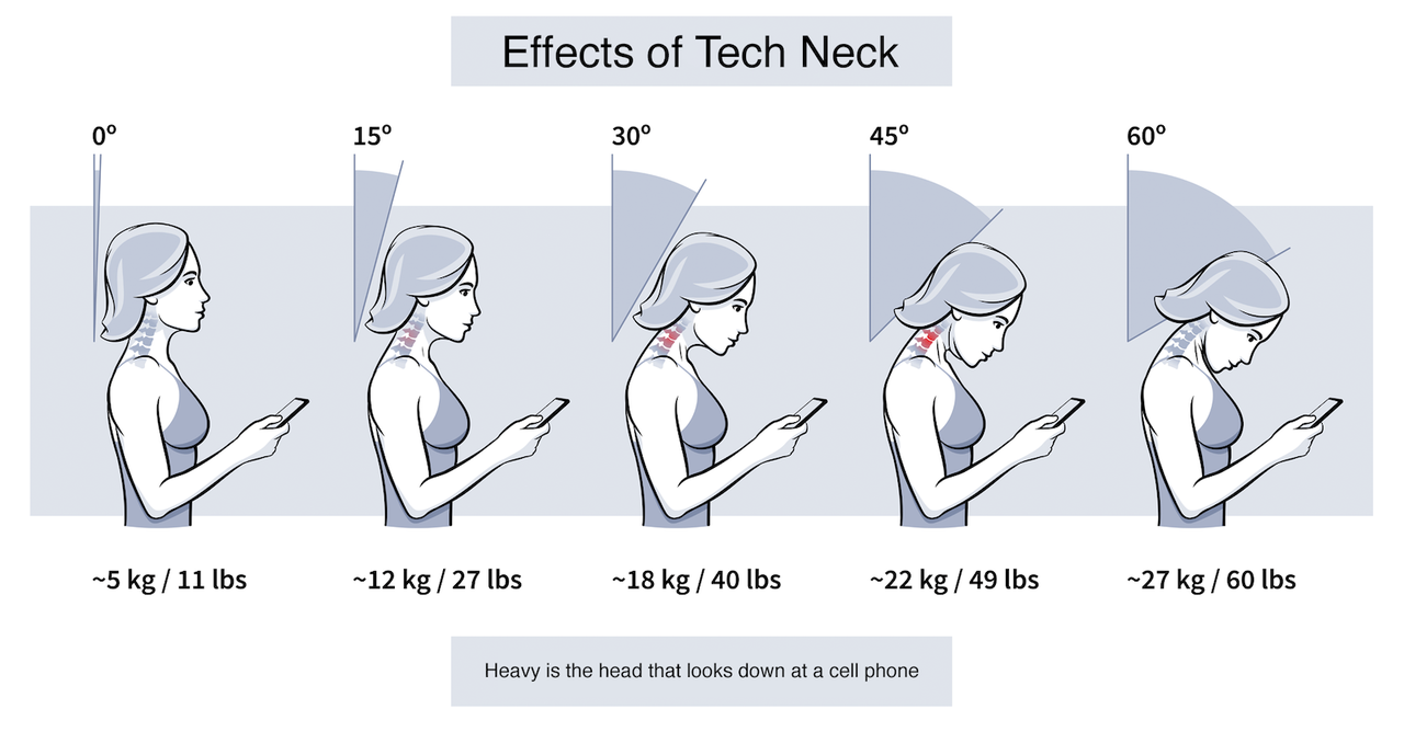  Tech Neck Epidemic How To Treat The Rise In Chronic Neck Pain Back 
