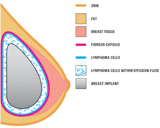 Breast Image_FDA_320