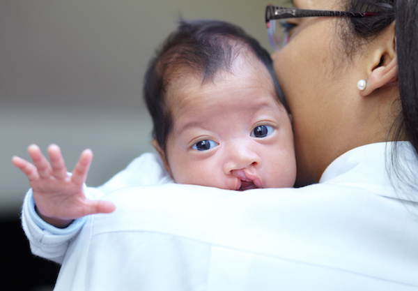 What parents need to know about cleft lip and palate