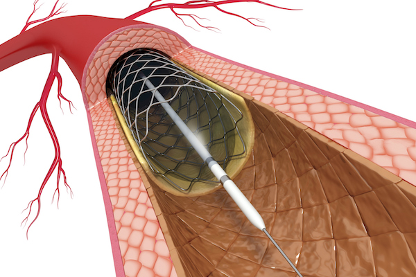 How PCI Stenting Can Reduce Chest Pain And Heart Attack Damage How PCI Stenting Can Reduce Chest Pain And Heart Attack Damage