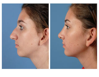 Dr Trussler Rhinoplasty Austin