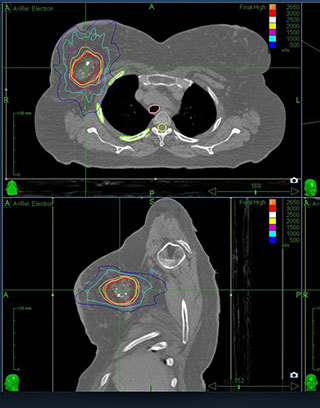 imaging showing cross section of person with the targets highlighted for radiation therapy