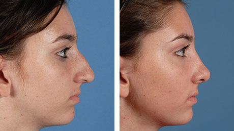 Cosmetic Body Surgery Before and After Image Gallery – Top Ranked Zuckerman  Plastic Surgery