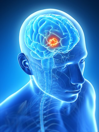 Brain tumor