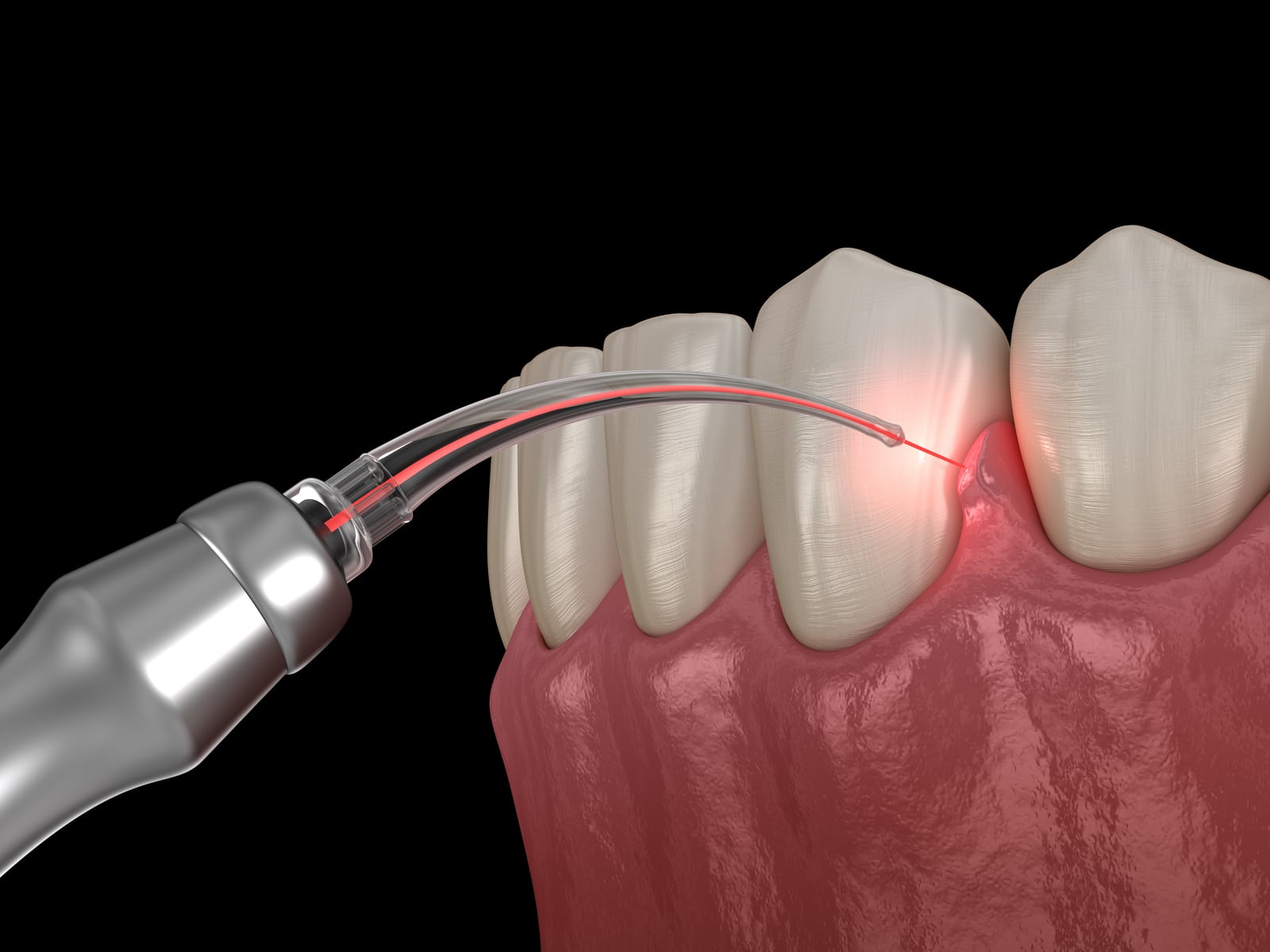 Laser surgery for gum disease