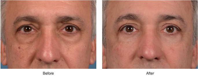 Puffy Eyes and Bags with Eyelid Surgery