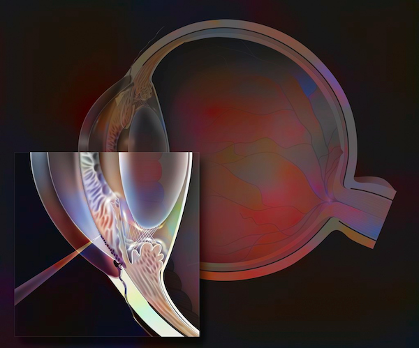 Glaucoma surgery illustration