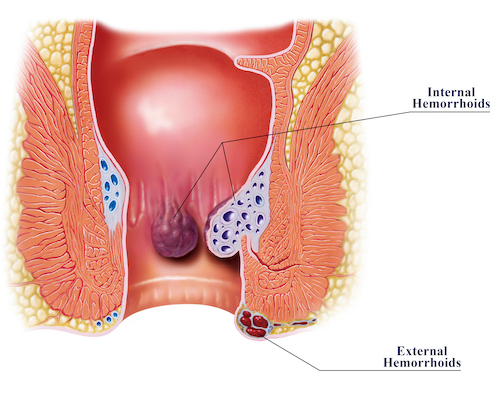 stage ii hemorrhoids internal