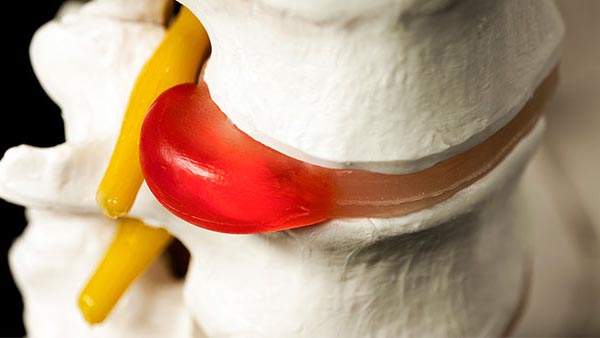 Herniated Disc Spine Center Condition UT